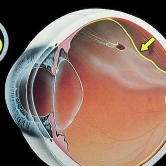 desprendimiento de retina